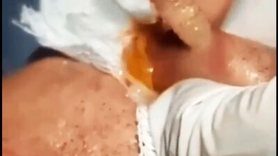 Извлечение личинки овода из губы